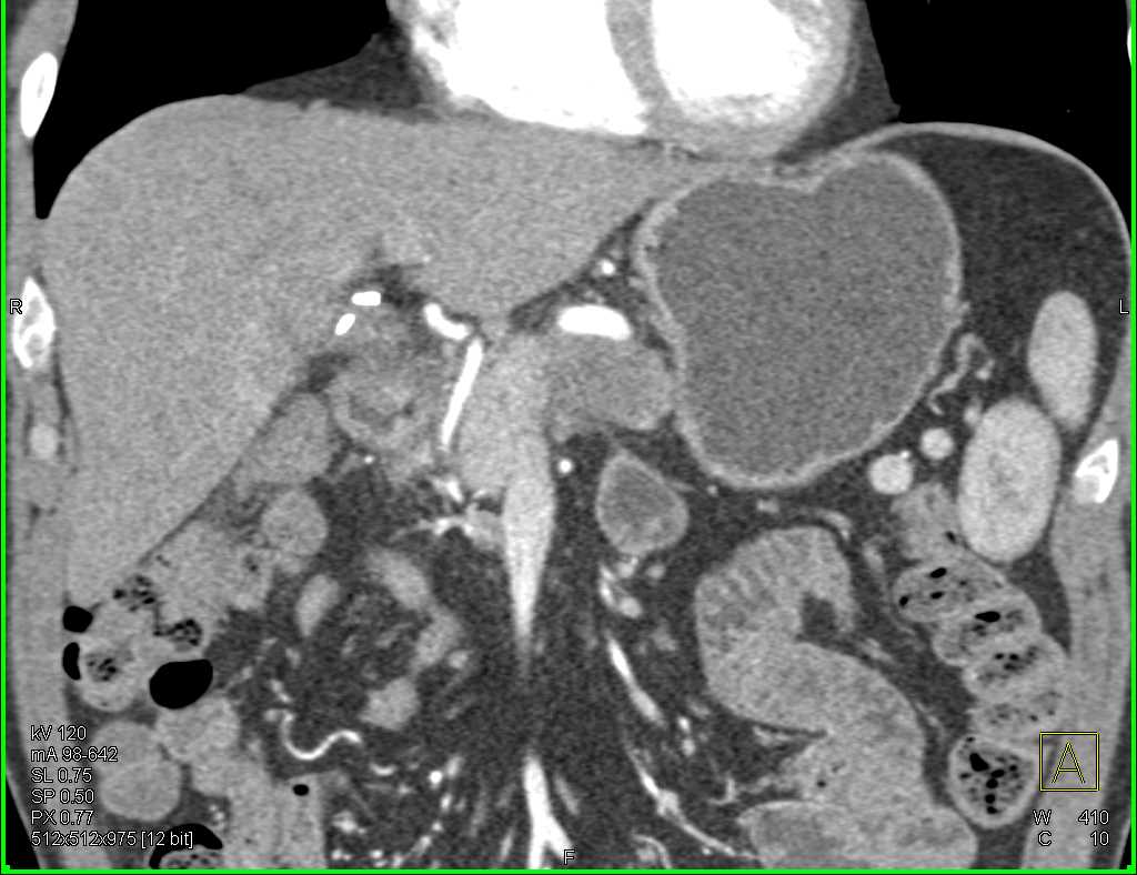 Pancreas Adenocarcinoma - CTisus CT Scan