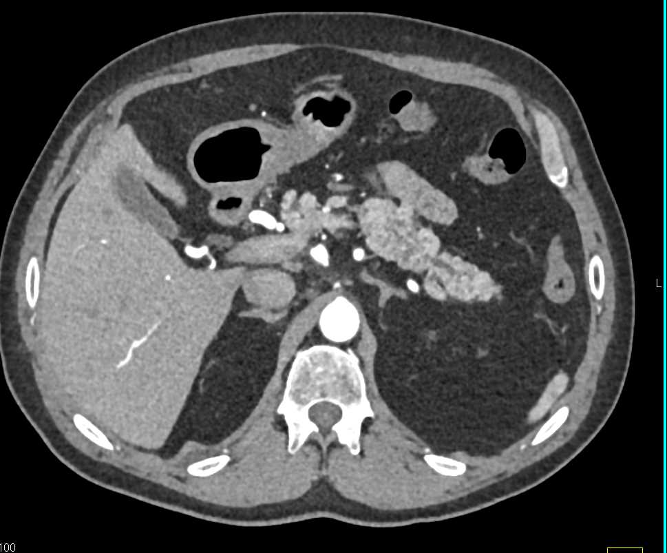 Carcinoma Head of Pancreas - CTisus CT Scan