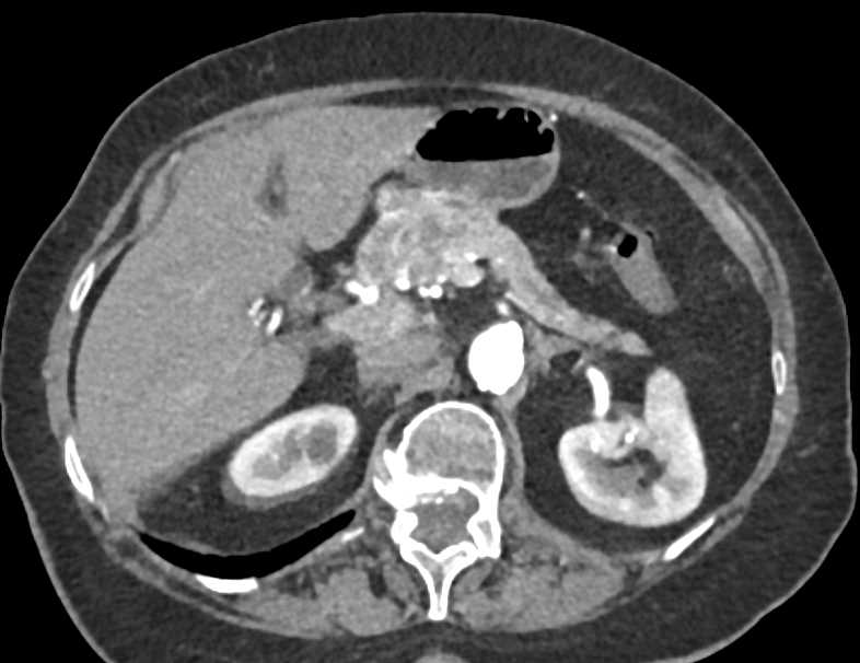 Carcinoma Head of Pancreas - CTisus CT Scan