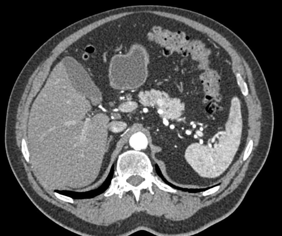 1cm Pancreatic Neuroendocrine Tumor (PNET) Body of Pancreas - CTisus CT Scan