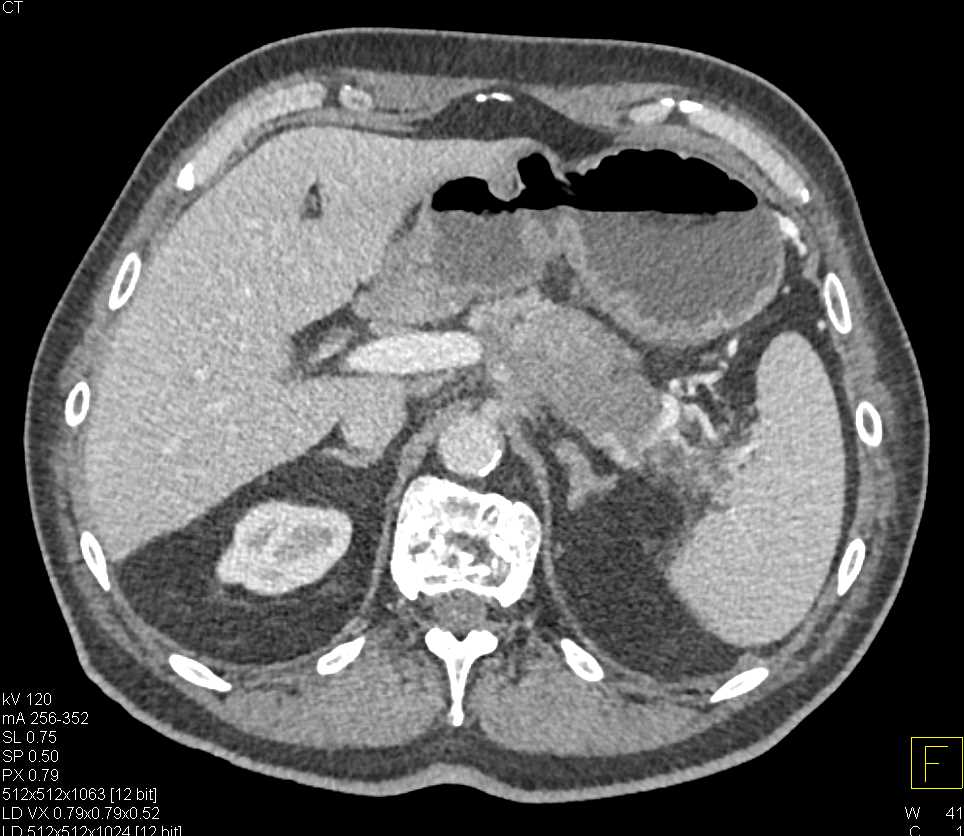 Carcinoma Body and Tail of Pancreas - CTisus CT Scan