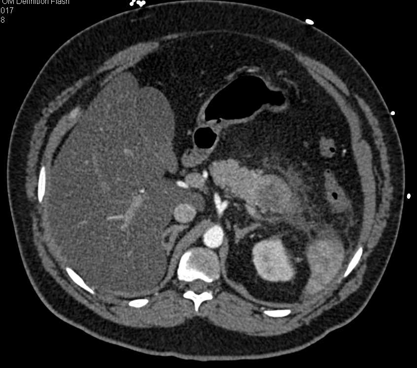 Acute Pancreatitis - CTisus CT Scan