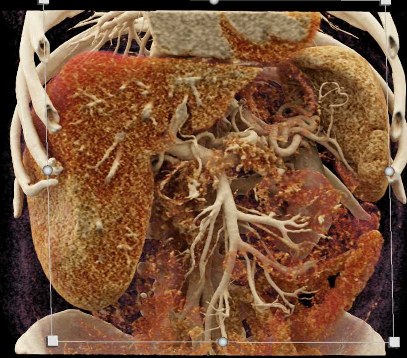 Adenocarcinoma Pancreas - CTisus CT Scan