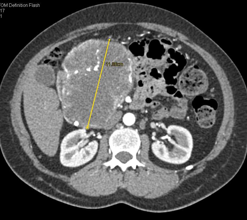 Serous Cystadenoma Pancreas - CTisus CT Scan