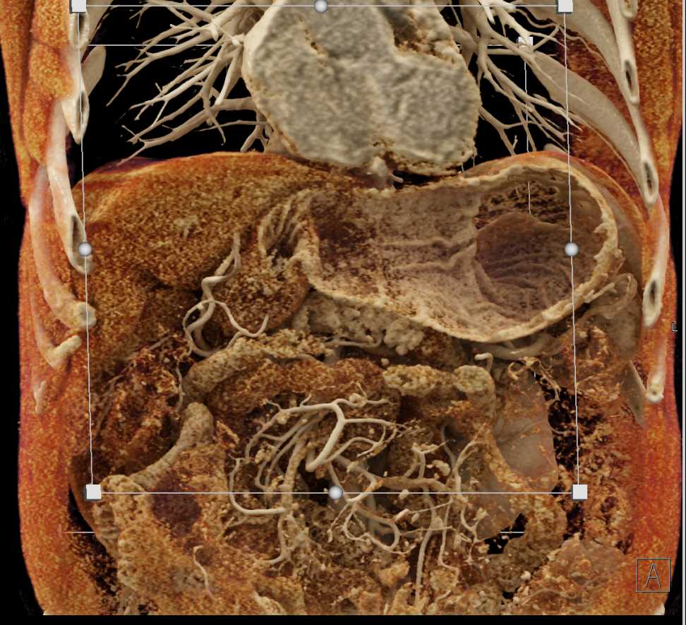 Carcinoma Tail of the Pancreas - CTisus CT Scan