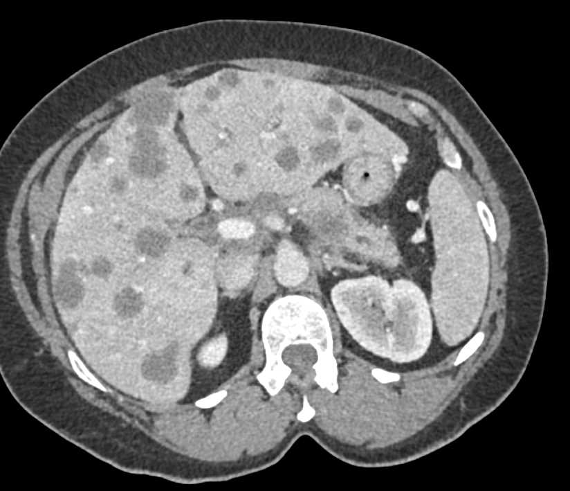 Pancreatic Adenocarcinoma with Liver Metastases - CTisus CT Scan