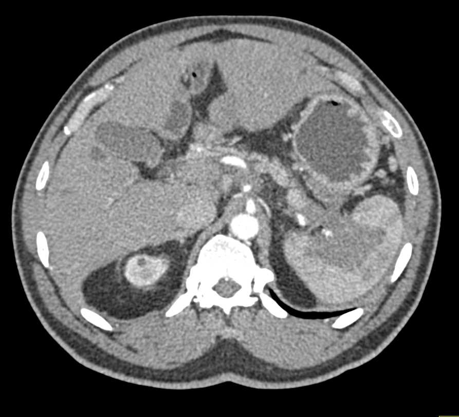 Carcinoma Tail of Pancreas Involves the Spleen - CTisus CT Scan