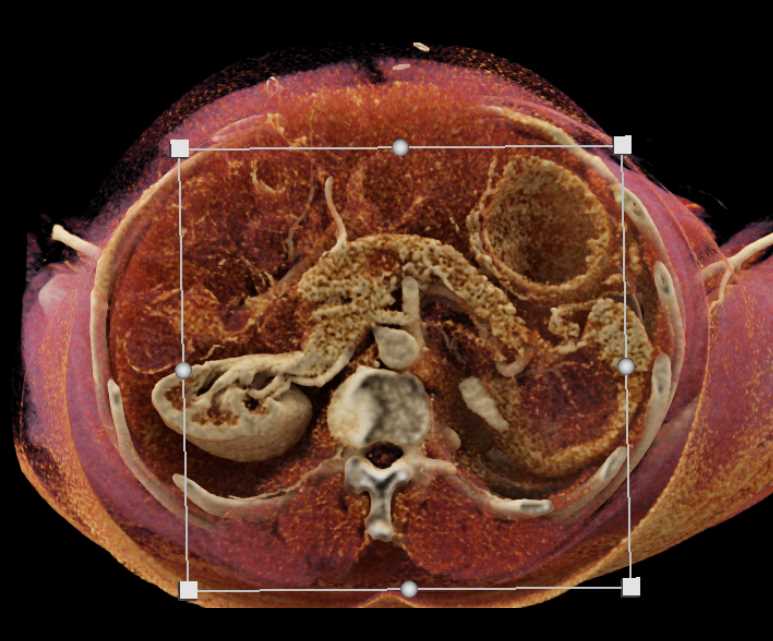 Carcinoma Tail of Pancreas Involves the Spleen - CTisus CT Scan