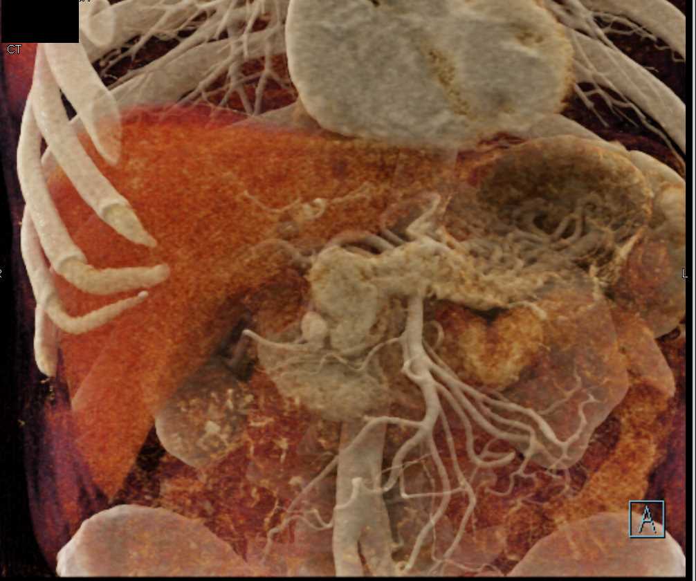 Carcinoma Head of Pancreas - CTisus CT Scan