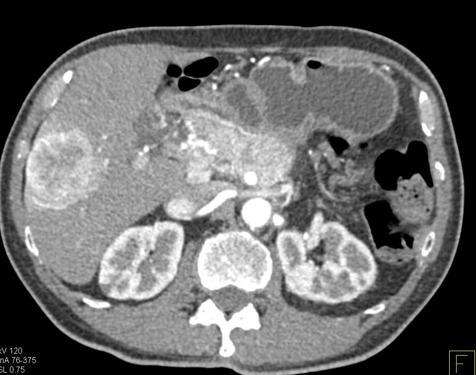 Neuroendocrine Tumor Pancreas with Liver Metastases - CTisus CT Scan