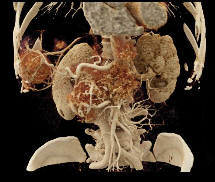 Neuroendocrine Tumor Pancreas with Liver Metastases - CTisus CT Scan