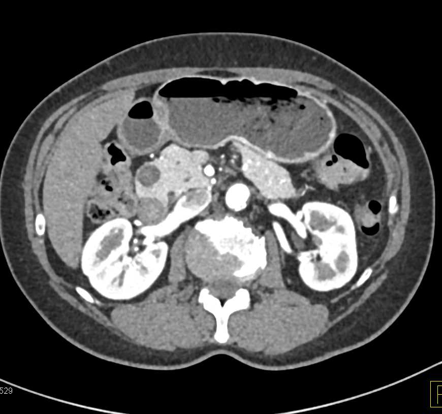 1cm Solid and Papillary Epithelial Neoplasm (SPEN) Tumor - CTisus CT Scan