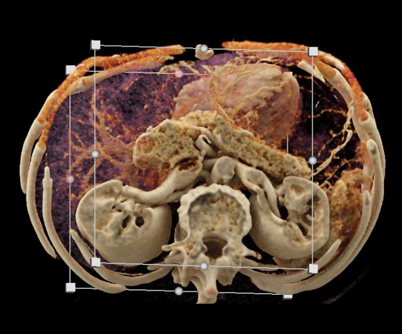 1cm Solid and Papillary Epithelial Neoplasm (SPEN) Tumor - CTisus CT Scan