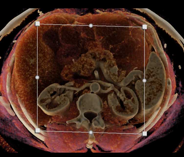 Neuroendocrine Tumor Tail of Pancreas - CTisus CT Scan