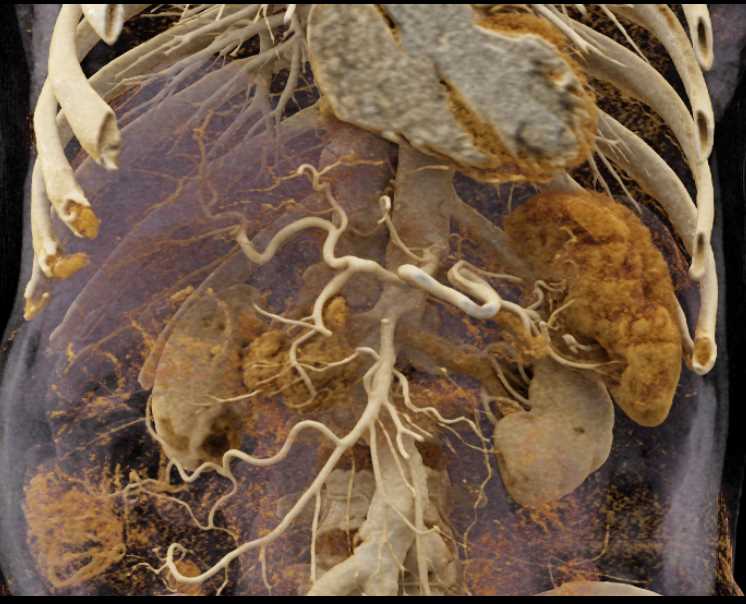 Adenocarcinoma Body of Pancreas - CTisus CT Scan