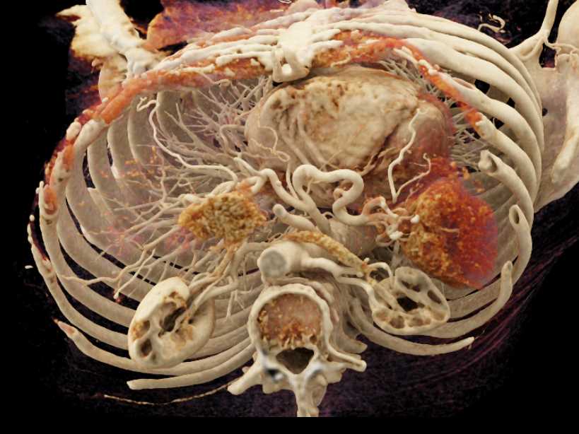 Adenocarcinoma Body of Pancreas with Cinematic Rendering - CTisus CT Scan