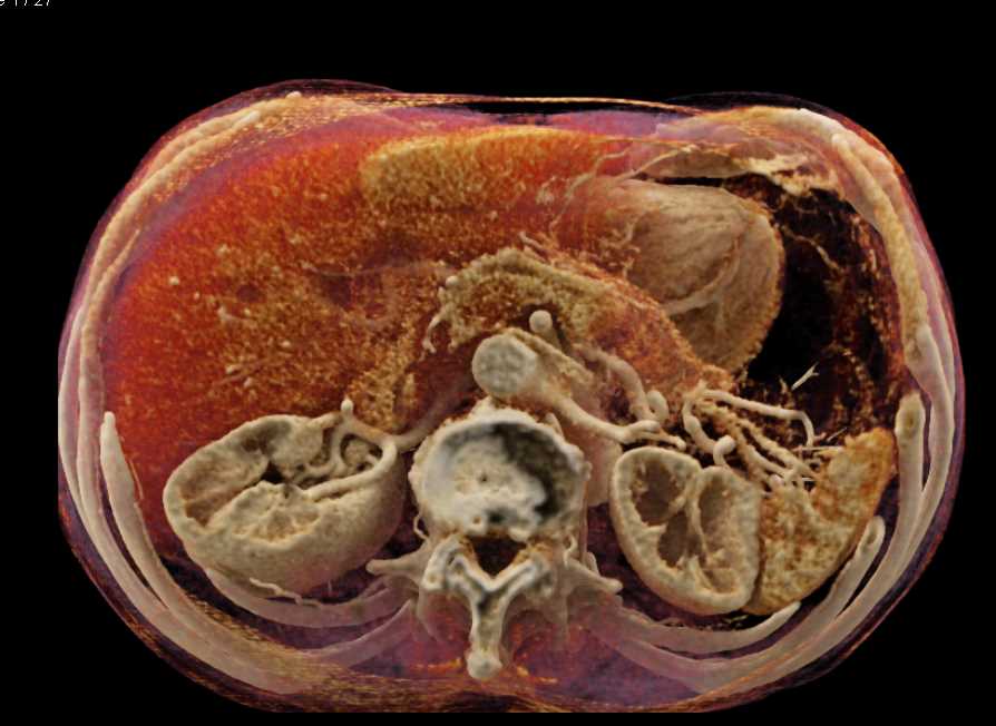 Carcinoma Body of the Pancreas - CTisus CT Scan