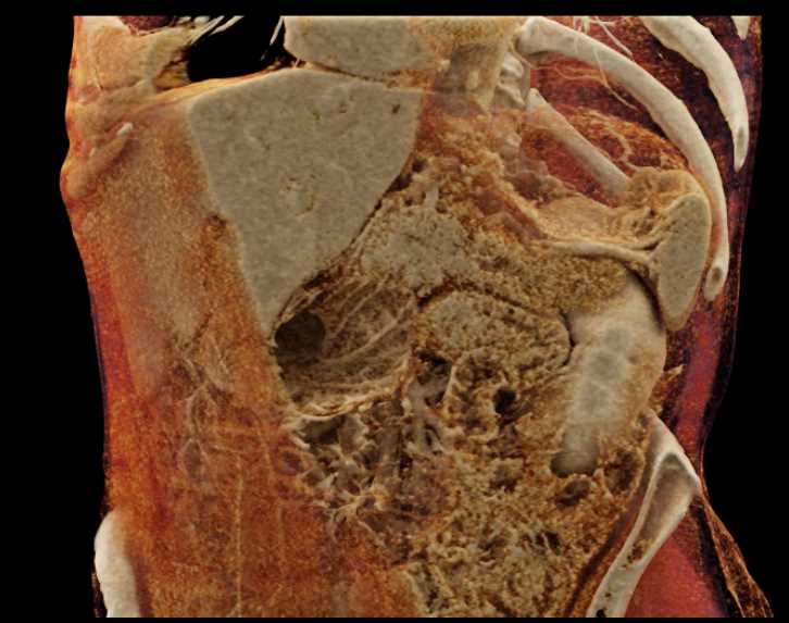 Carcinoma Body of the Pancreas - CTisus CT Scan