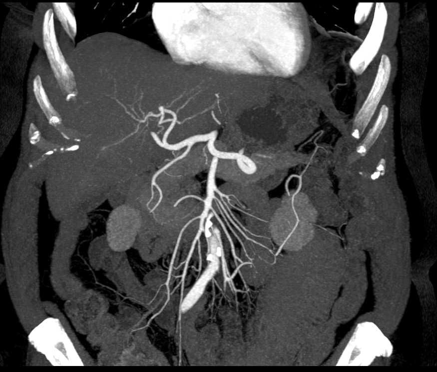 Intraductal Papillary Mucinous Neoplasm (IPMN) Head of Pancreas - CTisus CT Scan