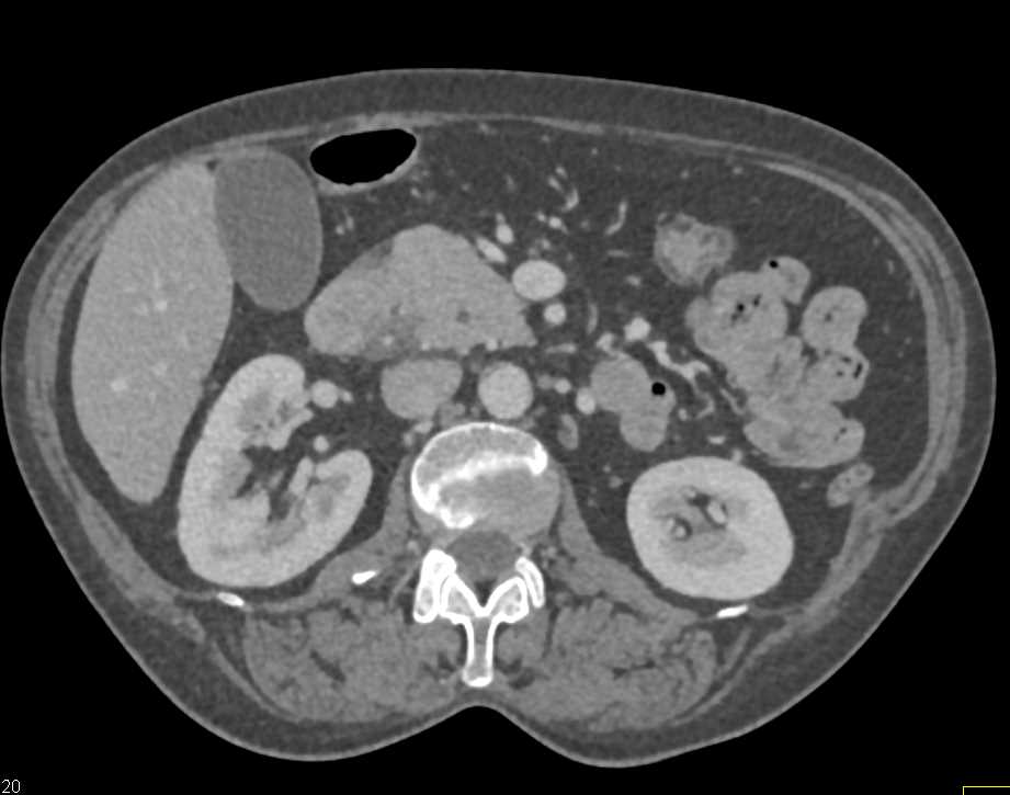 Pancreatic Adenocarcinoma - CTisus CT Scan
