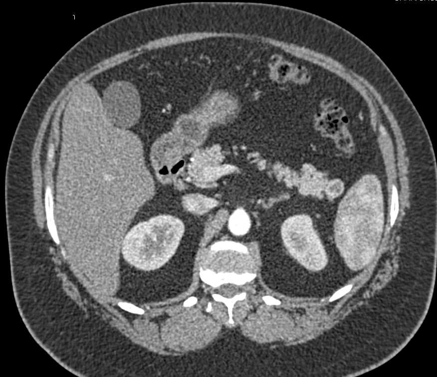 Pancreatic Neuroendocrine Tumor (PNET) Tail of Pancreas - CTisus CT Scan