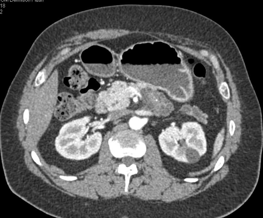 Carcinoma of the Pancreas Arises from a Main Duct Intraductal Papillary Mucinous Neoplasm (IPMN) - CTisus CT Scan