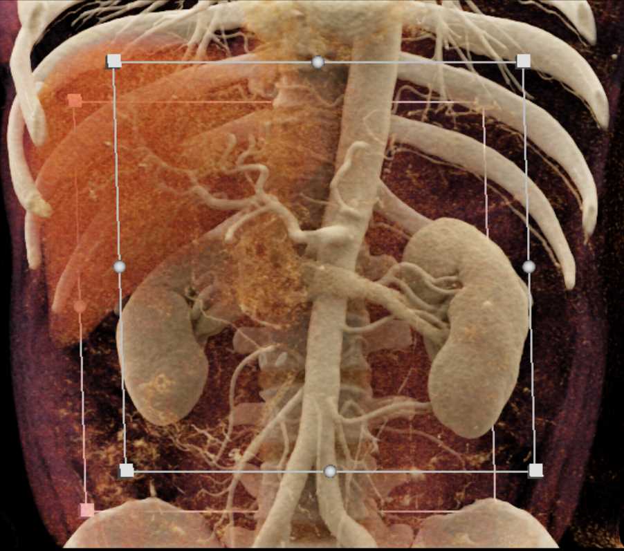 Solid and Papillary Epithelial Neoplasm (SPEN) Tumor Pancreas - CTisus CT Scan
