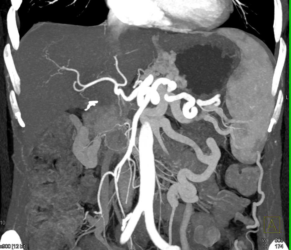 Pancreatic Cancer with Cavernous Transformation of the Portal Vein - CTisus CT Scan