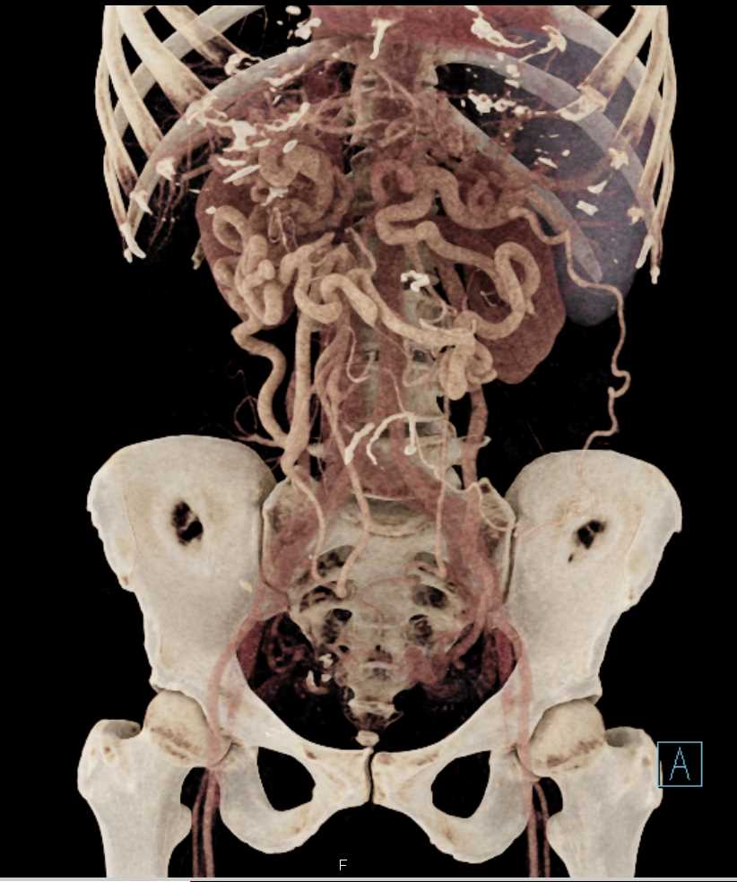 Pancreatic Cancer with Cavernous Transformation of the Portal Vein - CTisus CT Scan