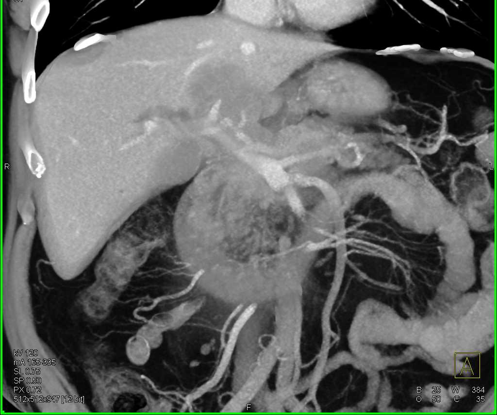 Pancreatic Cancer Encases the Celiac and Superior Mesenteric Artery (SMA) - CTisus CT Scan