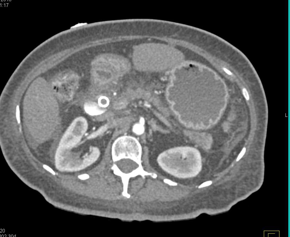 Pancreatic Cancer with Common Bile Duct (CBD) Stent - CTisus CT Scan