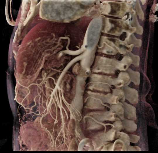 Pancreatic Cancer with Patent Superior Mesenteric Artery (SMA) and Celiac Arteries - CTisus CT Scan
