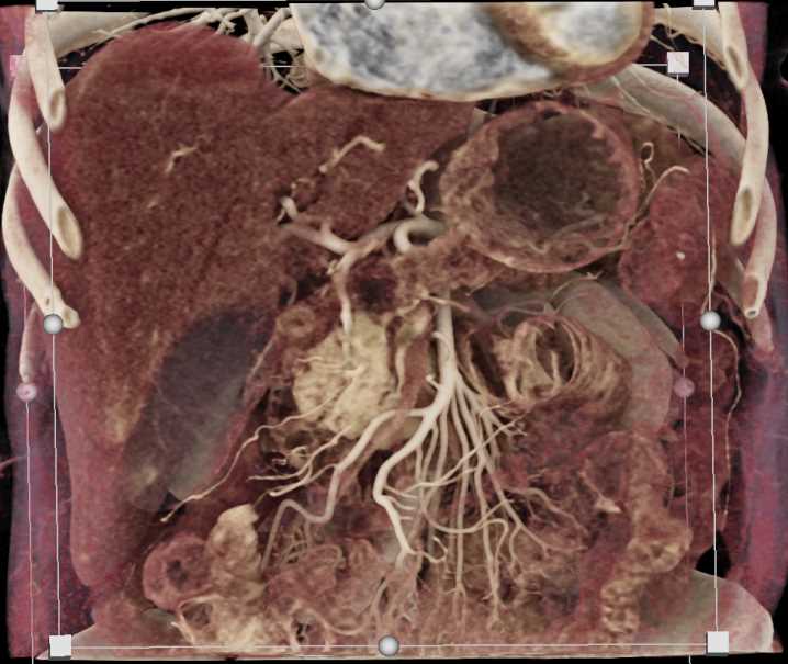 Pancreatic Cancer with Patent Superior Mesenteric Artery (SMA) and Celiac Arteries - CTisus CT Scan