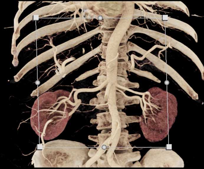 Normal Pancreas and Mesenteric Arcade with Cinematic Rendering - CTisus CT Scan