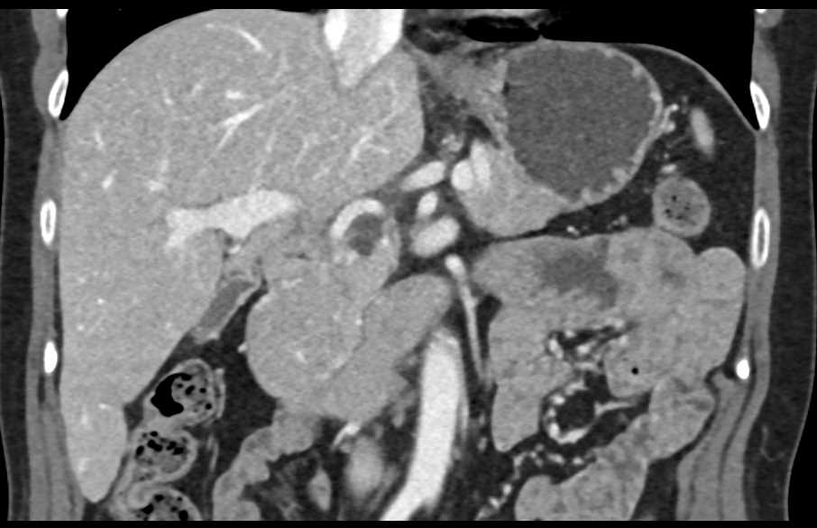 Intraductal Papillary Mucinous Neoplasm (IPMN) - CTisus CT Scan