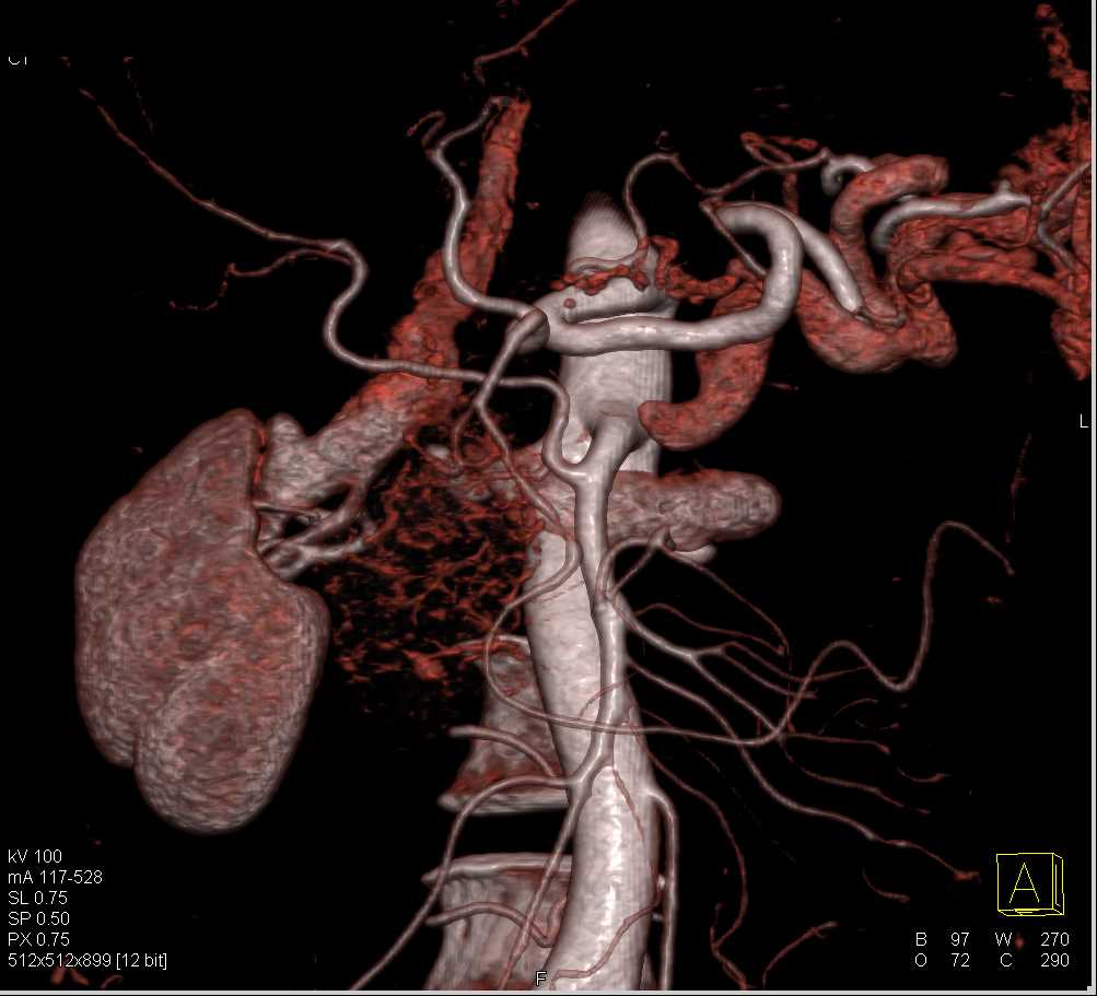 Pancreatic Cancer with Replaced Right Hepatic Artery off Superior Mesenteric Artery (SMA) and PV SMV Involvement - CTisus CT Scan