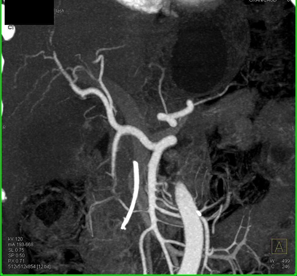Pancreatic Cancer with Replaced Right Hepatic Artery off Superior Mesenteric Artery (SMA) and PV SMV Involvement - CTisus CT Scan
