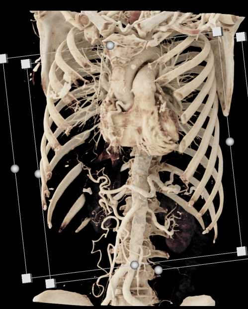 Pancreatic Neuroendocrine Tumor (PNET) Obstructs the Pancreatic Duct - CTisus CT Scan