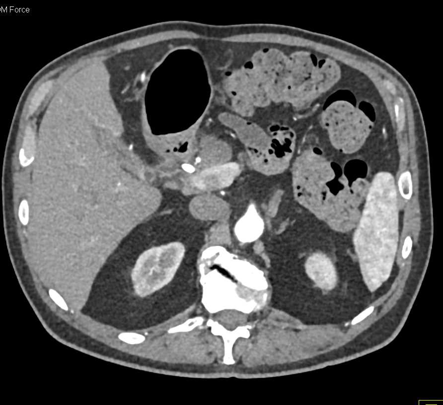 Carcinoma Head of Pancreas - CTisus CT Scan