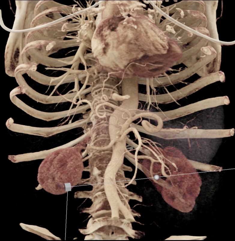 Pancreatic Pseudocysts - CTisus CT Scan