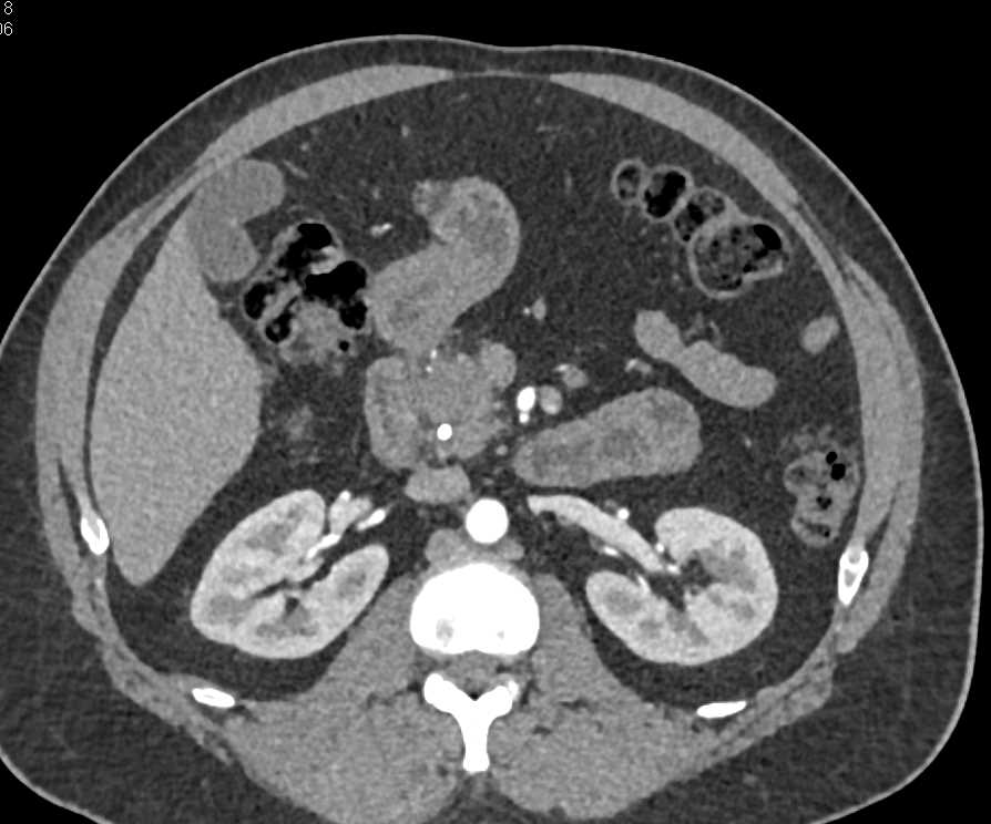 Pancreatic Cancer and Common Bile Duct (CBD) Stent - CTisus CT Scan