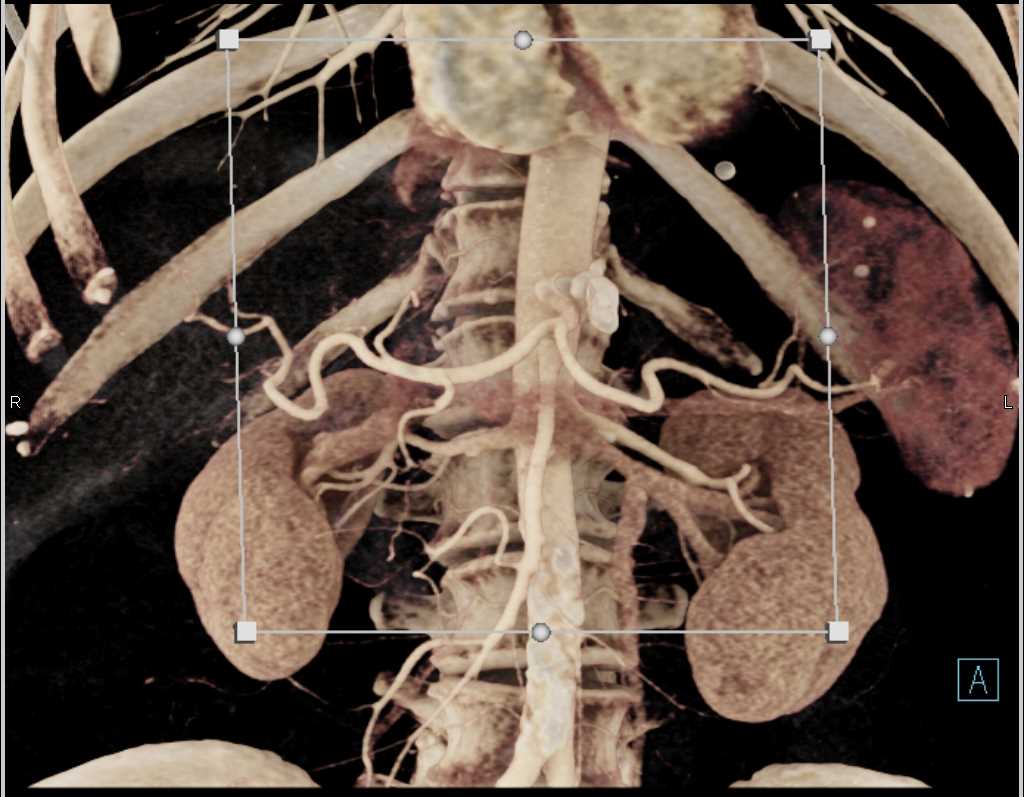 Textural Changes in the Pancreas - CTisus CT Scan
