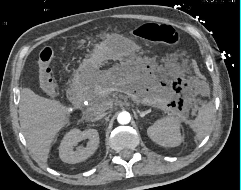 Acute Pancreatitis with Pancreatic Necrosis - CTisus CT Scan