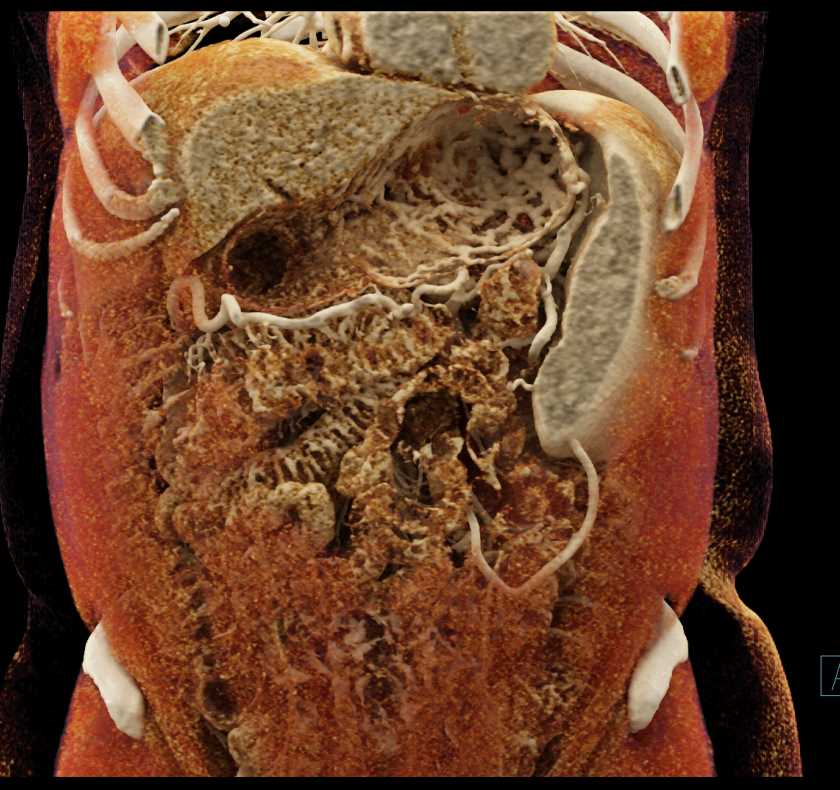Carcinoma Tail of Pancreas - CTisus CT Scan