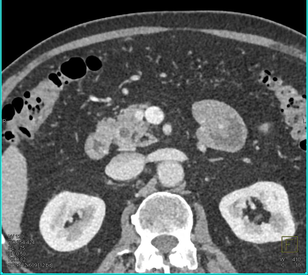 1cm Pancreatic Neuroendocrine Tumor (PNET) Head of Pancreas - CTisus CT Scan