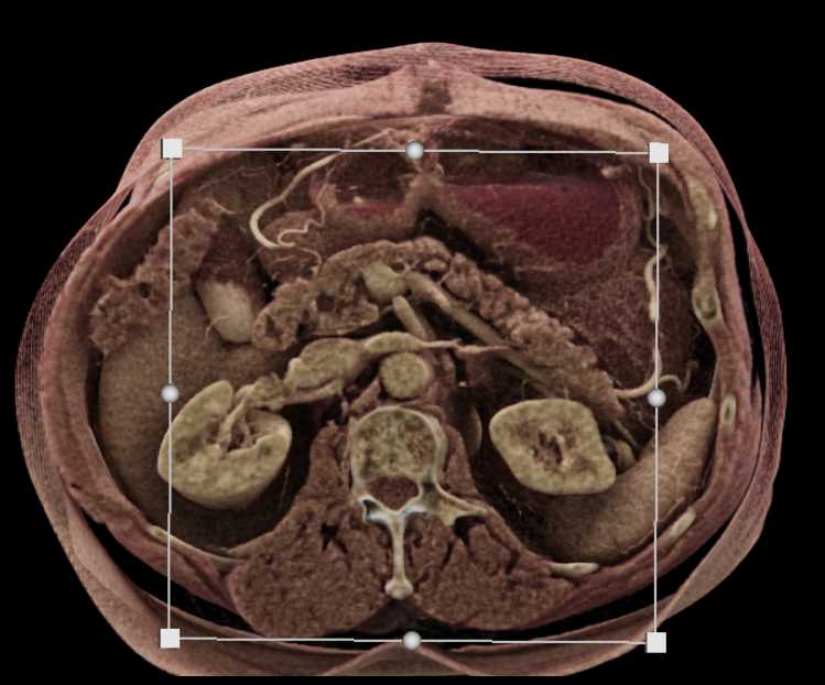 1cm Pancreatic Neuroendocrine Tumor (PNET) Head of Pancreas - CTisus CT Scan