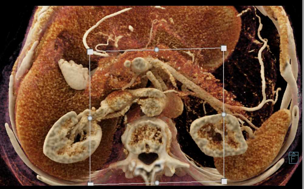 1cm Pancreatic Neuroendocrine Tumor (PNET) Head of Pancreas - CTisus CT Scan