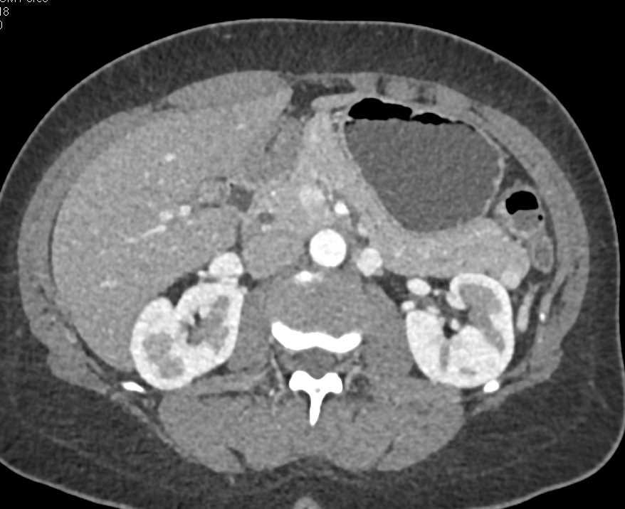 Superior Mesenteric Vein (SMV) Simulates a Pancreatic Neuroendocrine Tumor (PNET) - CTisus CT Scan