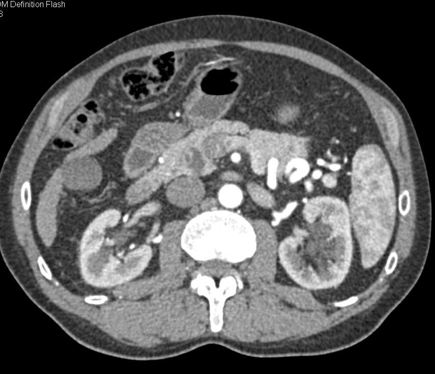 Intraductal Papillary Mucinous Neoplasm (IPMN) Head of Pancreas - CTisus CT Scan