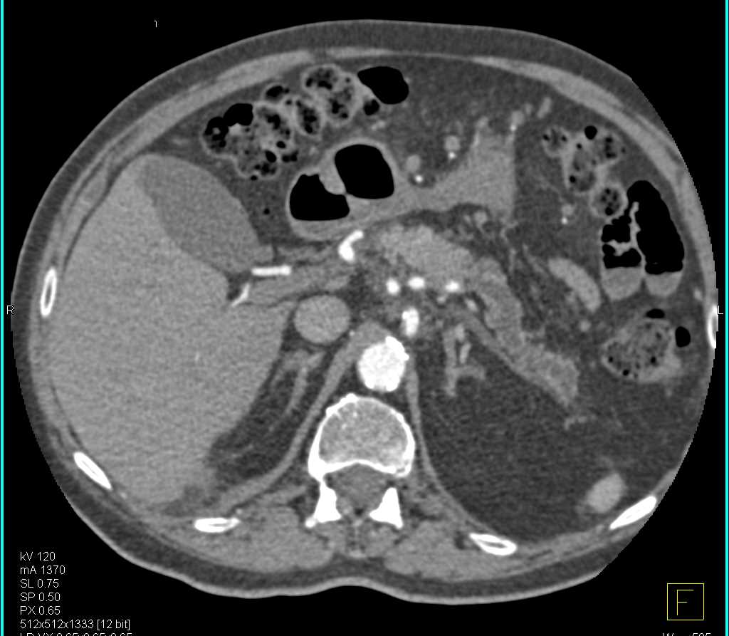 Main Duct Intraductal Papillary Mucinous Neoplasm (IPMN) - CTisus CT Scan